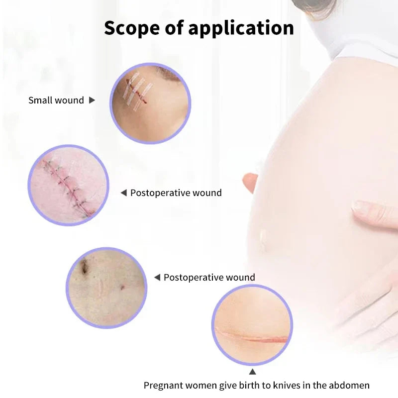 5 Strips Wound Skin Closure Strips | Medical Suture Free Surgical Tape