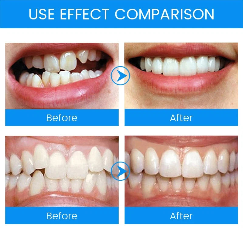 3 Stages Dental Orthodontic Braces Teeth Retainer | Anti Snoring Mouth Guard