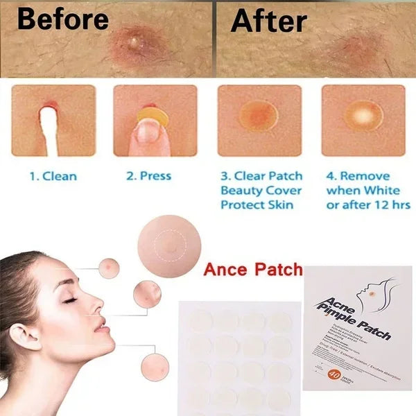24 Pcs Hydrocolloid Acne Patches | Pimple Spot Treatment Stickers for Face