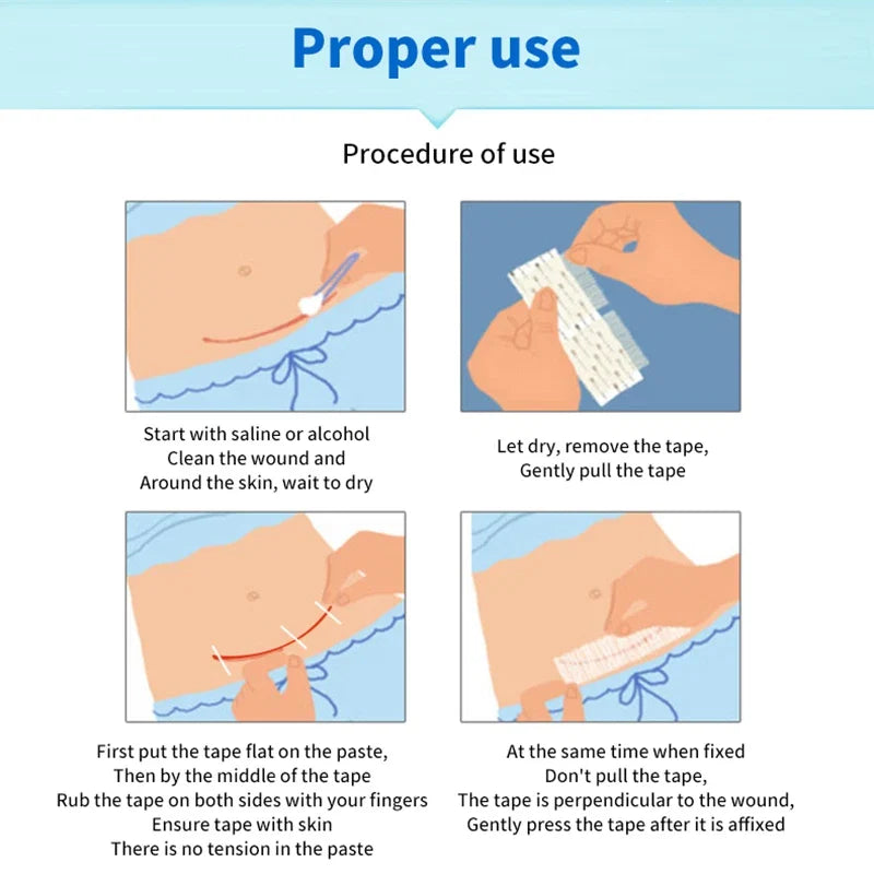 5 Strips Wound Skin Closure Strips | Medical Suture Free Surgical Tape