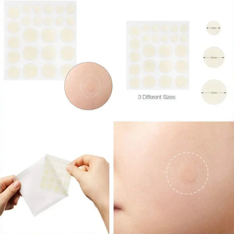24 Pcs Hydrocolloid Acne Patches | Pimple Spot Treatment Stickers for Face